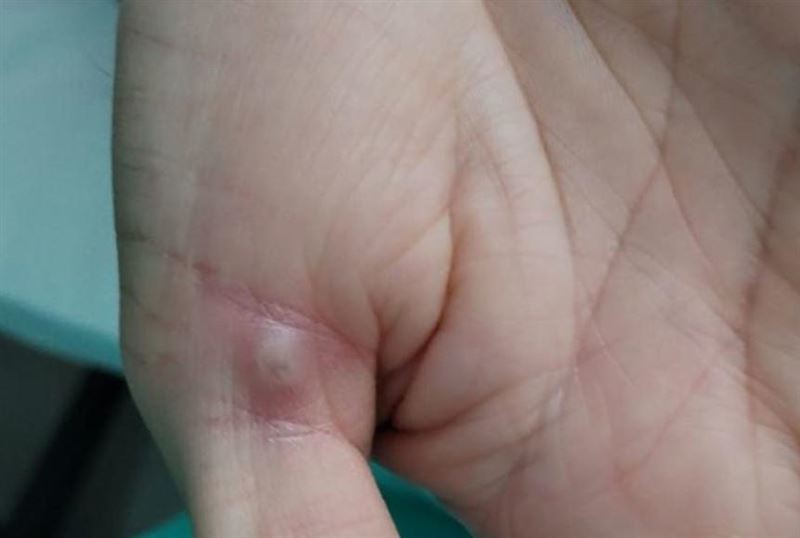 Маймыл шешегін жұқтырғандар саны, тіпті көп болуы мүмкін - ДДСҰ 