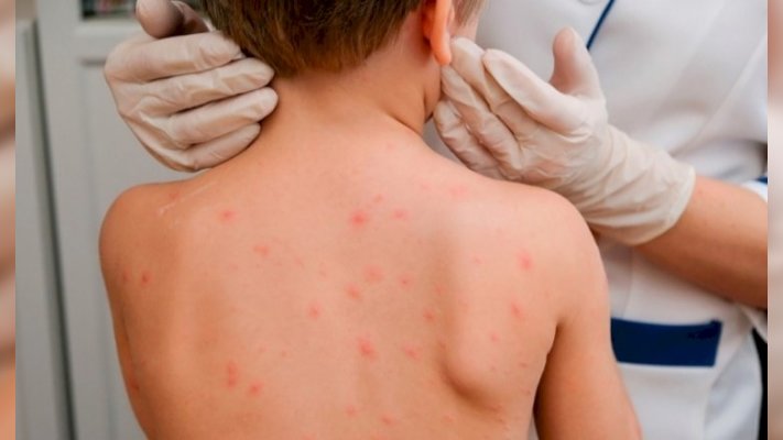 Алматы облысында қызылша жұқтырғандар көбейді