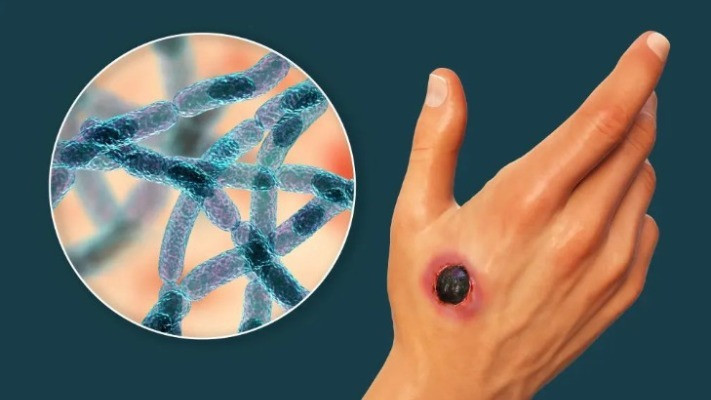 Сібір жарасы — аса кауіпті жұқпалы ауру